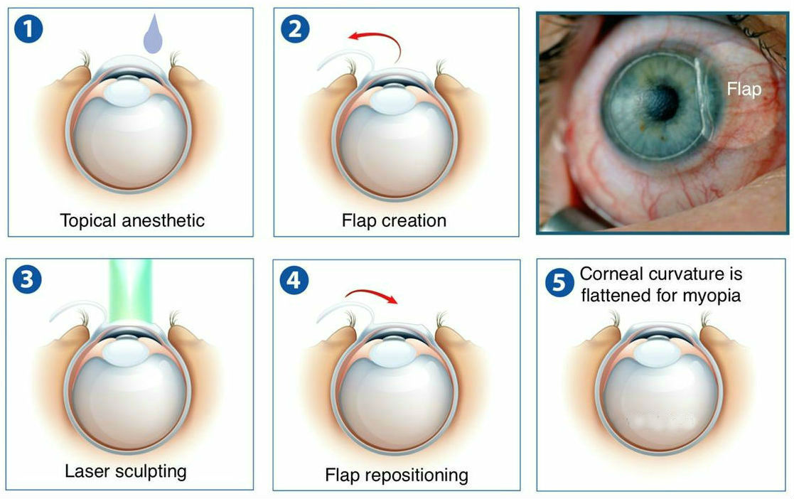 Lasik Laser at LJ Eye Institute