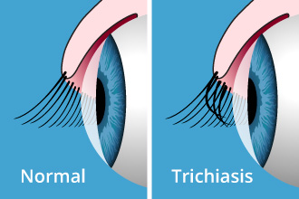 cornea transplants