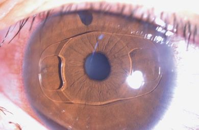 iris-claw-lens