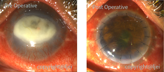 therapeutic-penetrating-keratoplasty pre and post