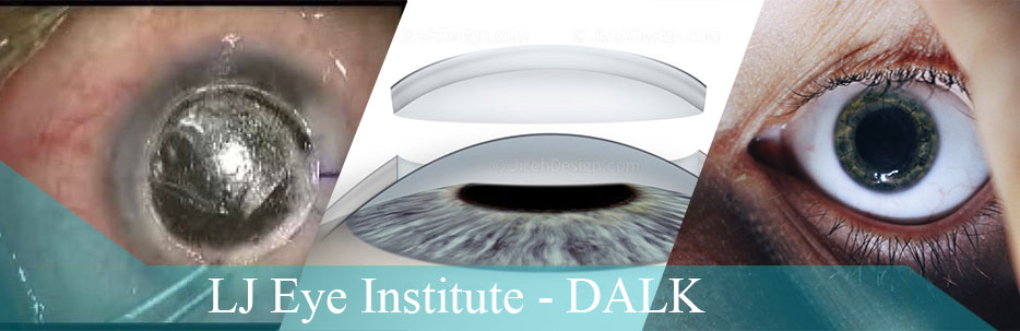 DALK LJ Eye Institute