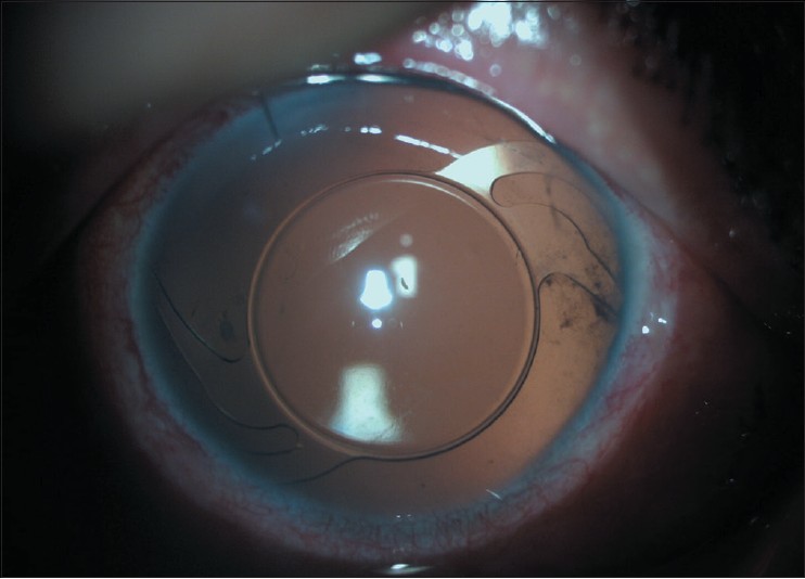 scleral-fixated-intraocular-lens