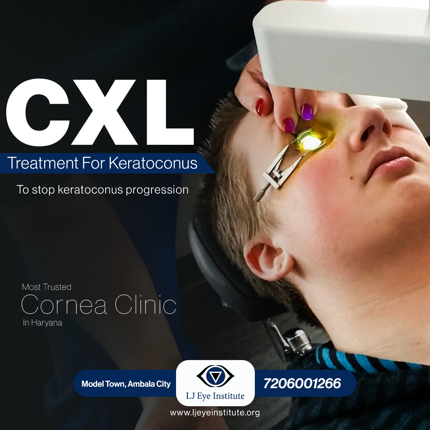 CXL Corneal Collagen Cross Linking at LJ Eye Institute