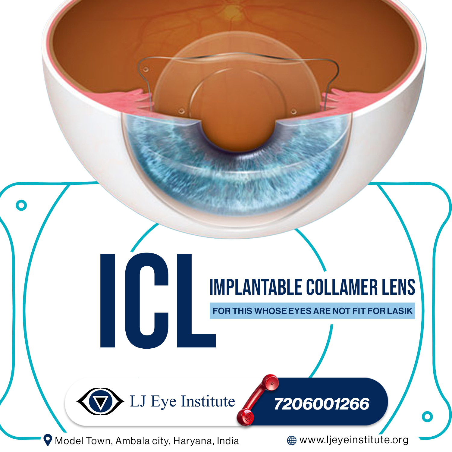 Eyes ICl Surgery in Ambala