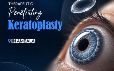 Therapeutic Penetrating Keratoplasty (TPK) in Ambala